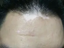 Dispositivos de fototerapia para Psoriasis en casa, lámpara de mano de banda estrecha para Vitiligo Eczema UVB 311NM, luz ultravioleta de Vitiligo de banda estrecha