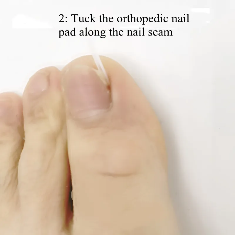 

Вкладыши для вросшего онихомикоза, Ортодонтические наклейки для ногтей, кусачки для ногтей