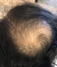 Suero para el crecimiento del cabello de jengibre, tratamiento para la pérdida del cabello con Spray, aceite esencial para el crecimiento del cabello Germinal efectivo en 7 días, cuidado del cabello para hombres y mujeres, 30ml