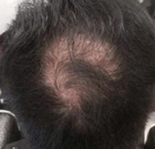 PURC-pulverizador para el crecimiento del cabello para hombres y mujeres, tratamiento para la pérdida de cabello de rápido crecimiento, productos de belleza para el cuidado del cabello, 30ml