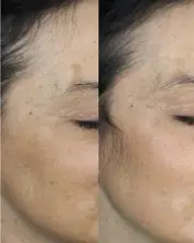 Freckle-Removal-Cream Whitening Remove-Freckle Melanin Dark-Spot Anti-Aging Omy Lady