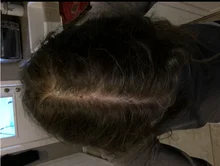 HAIRCUBE-esencia para el crecimiento del cabello, tratamiento para la pérdida del cabello, anticaída, prevención, Alopecia, líquido dañado, reparación del cabello