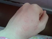 Dispositivos de fototerapia para Psoriasis en casa, lámpara de mano de banda estrecha para Vitiligo Eczema UVB 311NM, luz ultravioleta de Vitiligo de banda estrecha