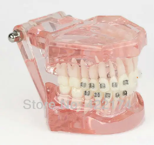 Halfmetal halfcemeric Ортодонтия модель зубной зубы стоматолог стоматология odontologia Tyodont модель