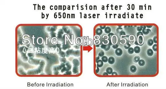 nose laser