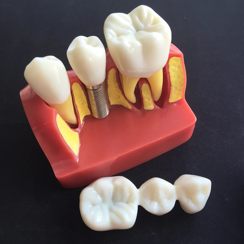 1 шт. зубной 4 раза имплантата болезни зубов Модель W/восстановление мост Корона оральный обучение исследование демонстрация для стоматологии