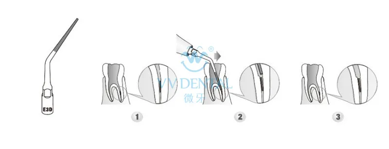 3 шт. ED3D Эндодонтический корневой канал чистящий наконечник для ударное оборудование SATELEC стоматологический скалер наконечник