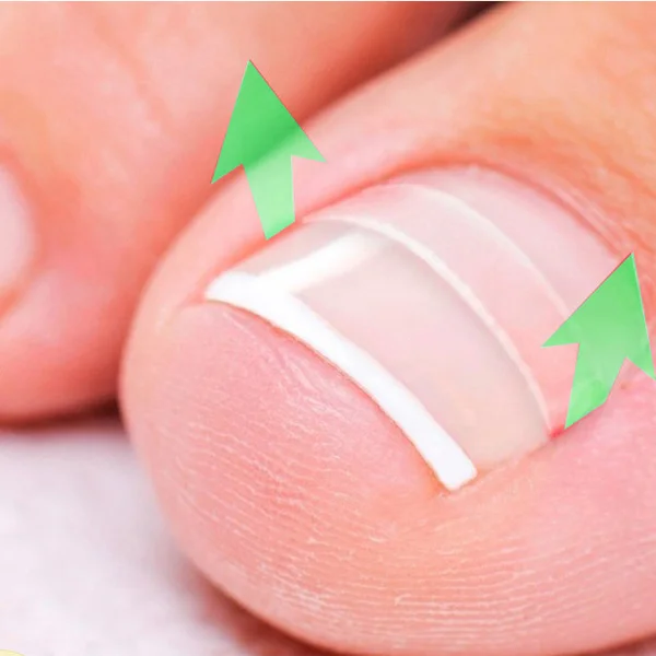 

NEW 10pcs/box Ingrown Toe Nail Correction Sticker Patch Paronychia Correction File Acronyx Wire Corrector Foot Care Tool 2018