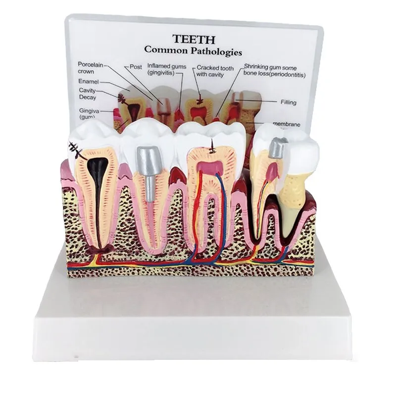 

Dental Teeth Common Pathologies Teaching Model Teeth Whitening Tooth Dentist for Medical Science Teach Demonstration