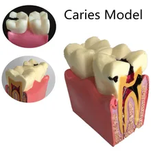 6X протеза модель кариеса сравнительная модель кариеса модель Стоматолог патологий для медицинские товары стоматологических заболев
