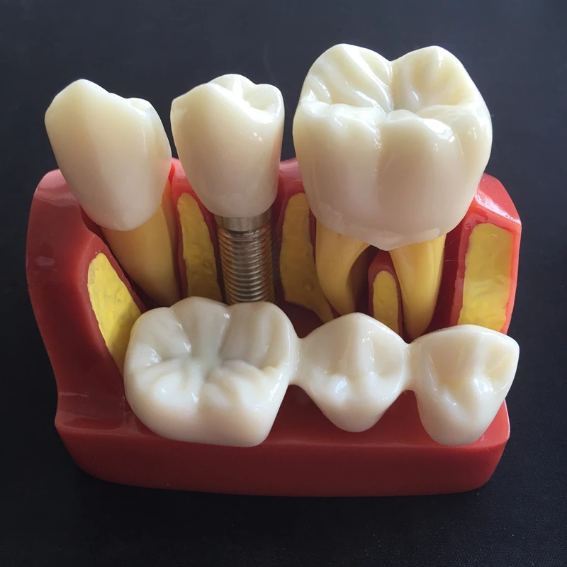 

1PC Dental 4 Times Implant Disease Teeth Model W/ Restoration Bridge Crown Oral Teaching Study Demonstration For Dentistry
