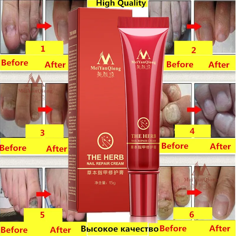 MeiYanQiong Herbal Nail Treatment Anti Fungal Cream Toe Nail Fungus