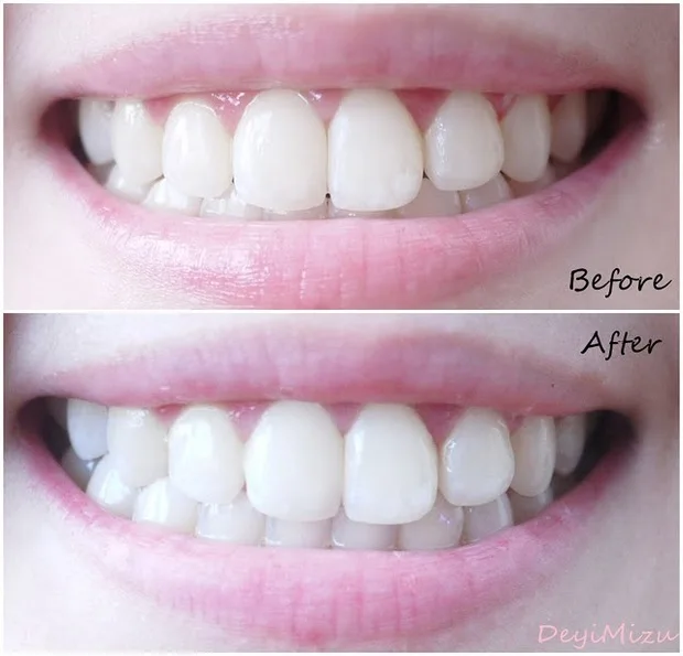 kit de clareamento dos dentes crista 3d branco whitestrips rotina suave caixa 1 14 malotes original profissional higiene oral strips 4 Beleza e saúde
