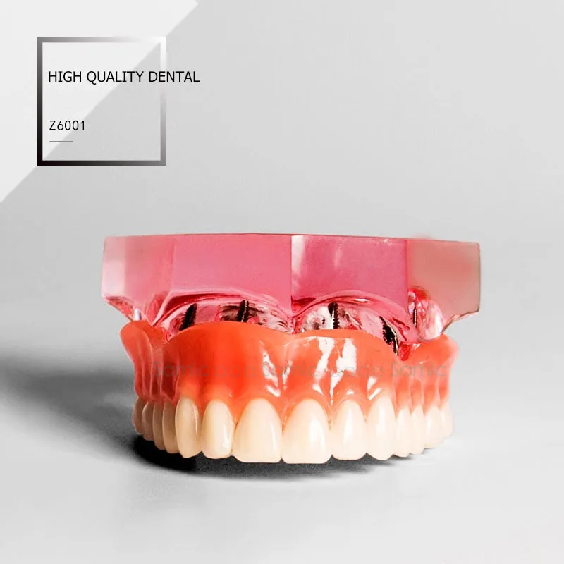 Dental Overdenture Улучшенный с 4 имплантатами демонстрационная модель