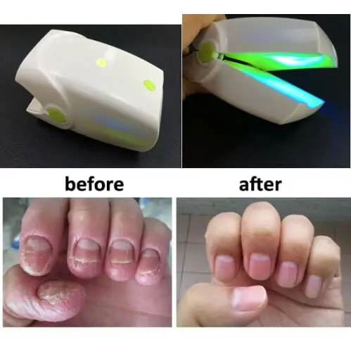 

2019 Nail Fungus Laser Therapy For Podiatry Nail Fungus With Cold Laser System 905nm Portable Device