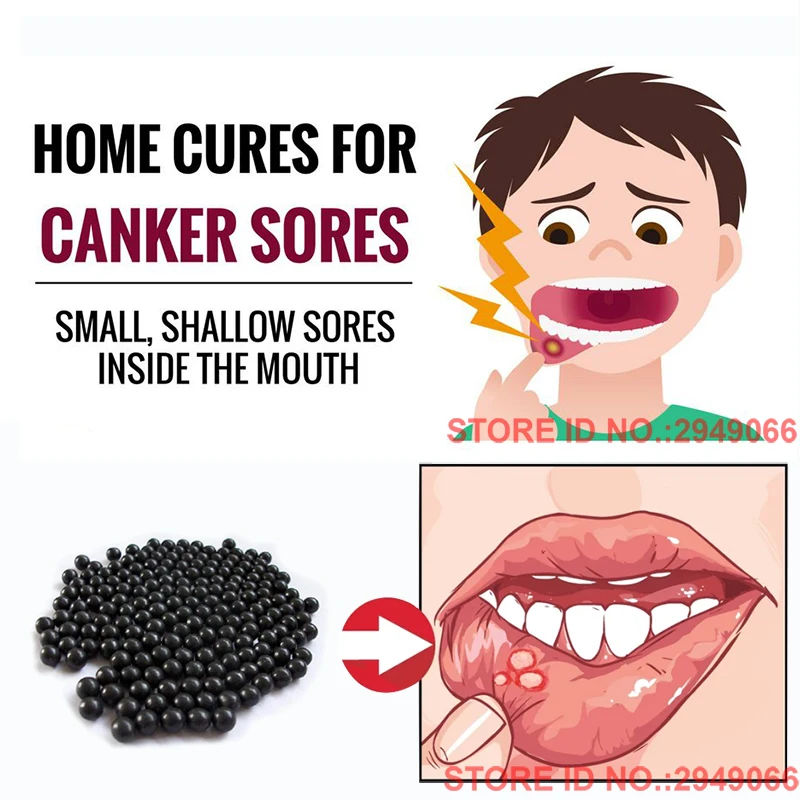 Chinese Formula Natural Herbs for Canker Sore Mouth Ulcer Mouth