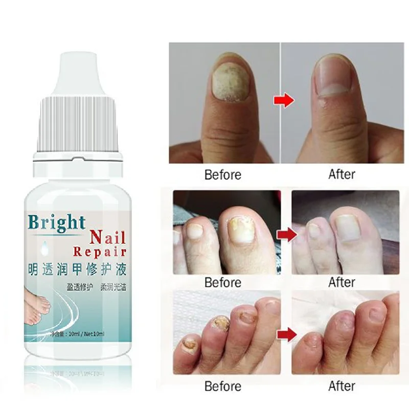 10ML Fungal Nail Treatment Essence Nail Foot Whitening Toe Nail Fungus Removal Feet Care Nail Gel for Onychomycosis TSLM2