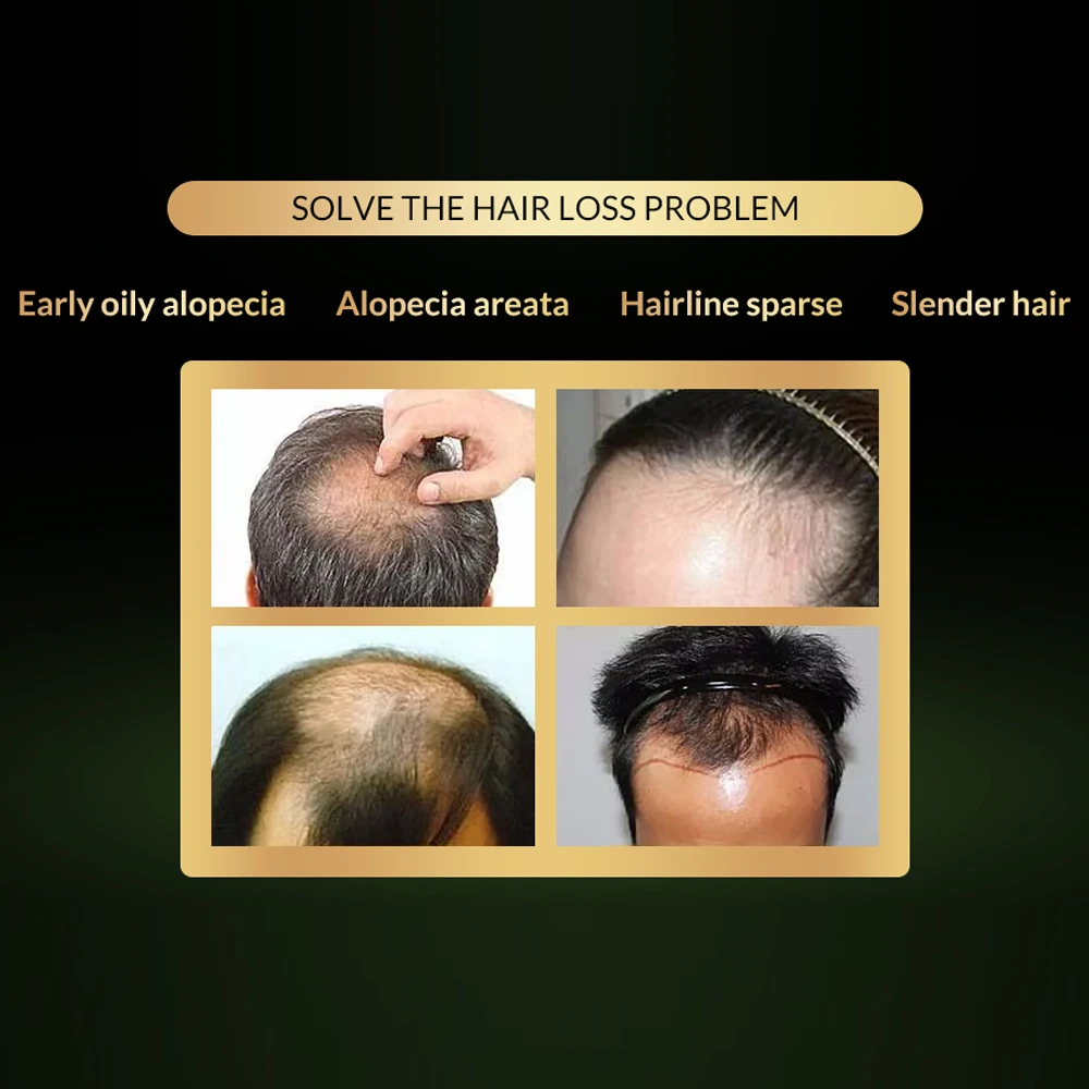 OMY LADY эссенция для роста волос масло против выпадения волос уход за волосами спрей для роста волос Oint men t для женщин/мужчин 20 мл плотный уход за здоровьем