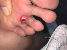 Parches médicos para el cuidado de los pies, almohadillas de eliminación de maíz, espinillas, parches curativos, elimina callosidades, desintoxicación, 30 Uds.