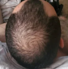 HAIRCUBE-esencia para el crecimiento del cabello, tratamiento para la pérdida del cabello, anticaída, prevención, Alopecia, líquido dañado, reparación del cabello