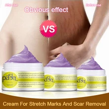

Maternity Stretch Marks Removal Cream Body Buttock Breast Mark Skin Care Effective Anti White Stretch Scar Remover Cream 50g