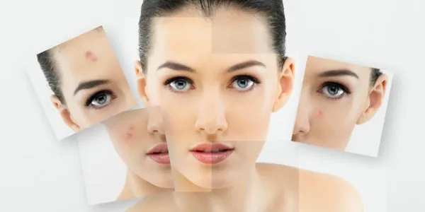 Expigment Hydroquinone 2% крем для Отбеливание кожи, осветляющая кожа, лечение меласмы 30 г/1 унции