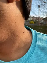 Kit de eliminación de verrugas y microbanda para la piel, eliminador de verrugas con hisopo de limpieza, topos y verrugas para adultos, cuidado facial