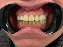 Abrelatas Dental de doble cabeza en forma de T, labio mejilla Intraoral, negro, 4 Uds.