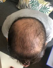 PURC-pulverizador para el crecimiento del cabello para hombres y mujeres, tratamiento para la pérdida de cabello de rápido crecimiento, productos de belleza para el cuidado del cabello, 30ml