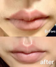 Máquina portátil de depilación, diodo láser de 808nm, Para rejuvenecimiento de la piel, máquina de depilación de 808nm, Envío Gratis