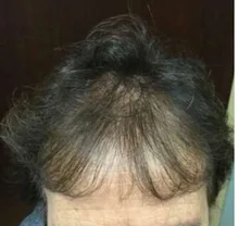 Champú y acondicionador para el crecimiento del cabello con queratina brasileña, conjunto para mejorar el crecimiento del cabello, regalos, previene el cuidado de las mujeres de 200ml