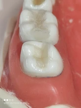 Kit de molde de impresión Dental Posterior, herramientas de llenado de restauración Dental