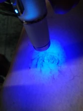 Lápiz láser para tratamiento de venas varicosas, lápiz láser para tratamiento de eliminación de cicatrices, arrugas, acné, masaje relajante