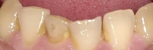 Limpiador Eliminador Electrico de Sarro Dental,  Dientes Blancos, Uso Domestico, 2 Cabezales, Luz Led, 2 años Garantía