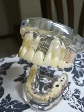 Modelo de dientes para implante Dental, modelo transparente para dentistas, estudiantes de aprendizaje, enseñanza, comunicación de investigación