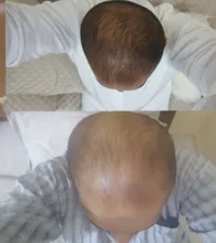 PURC-pulverizador para el crecimiento del cabello para hombres y mujeres, tratamiento para la pérdida de cabello de rápido crecimiento, productos de belleza para el cuidado del cabello, 30ml