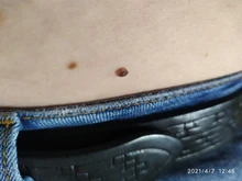 Kit de eliminación de verrugas y microbanda para la piel, eliminador de verrugas con hisopo de limpieza, topos y verrugas para adultos, cuidado facial