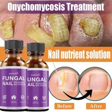 

Nail repair Fungal Nail Treatment Serum Foot Repair Essence Care Whitening Toe Nail Fungus Removal Gel Anti Infection 20ml