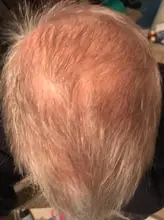 Champú para el crecimiento del cabello para hombres y mujeres, conjunto de regalo, espesante, productos para el cuidado de la caída del cabello, tratamiento de crecimiento del cabello, aceite SÉRUM