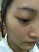 Crema blanqueadora para pecas, crema facial de hierbas chinas, elimina pecas y manchas oscuras, 30g