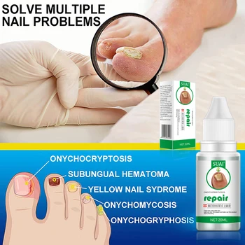 SUAI 20ML Nail Fungal Treatment Feet Care Essence Nail Foot Toe Nail Fungus Removal Gel Anti Infection Paronychia Onychomycosis