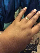 Dimollaure-suero de Ácido Kójico, esencia de ácido hialurónico, eliminación antienvejecimiento, blanqueamiento, cicatrices, pecas, Melasma, pigmento, suero de melanina