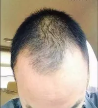 PURC-productos para el crecimiento del cabello para hombres y mujeres, aceite de crecimiento rápido, cuidado para la pérdida del cabello, tratamiento para el cuero cabelludo y el cabello, 30ml