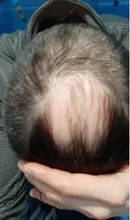 PURC-pulverizador para el crecimiento del cabello para hombres y mujeres, tratamiento para la pérdida de cabello de rápido crecimiento, productos de belleza para el cuidado del cabello, 30ml