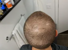 Suero para el crecimiento del cabello de jengibre, tratamiento para la pérdida del cabello con Spray, aceite esencial para el crecimiento del cabello Germinal efectivo en 7 días, cuidado del cabello para hombres y mujeres, 30ml