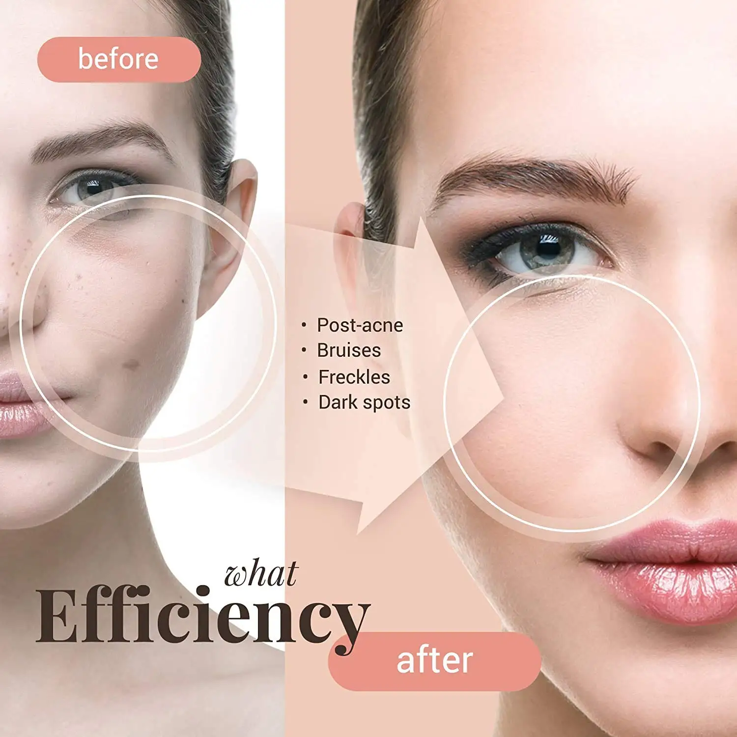 Whitening Freckle Cream Remove Melasma Acne Spot Pigment Melanin Dark Spots Pigmentation Freckle Removal Cream Moisturizing Gel