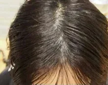 PURC-productos para el crecimiento del cabello para hombres y mujeres, aceite de crecimiento rápido, cuidado para la pérdida del cabello, tratamiento para el cuero cabelludo y el cabello, 30ml