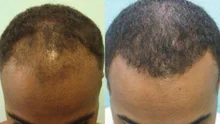 Champú y acondicionador para el crecimiento del cabello con queratina brasileña, conjunto para mejorar el crecimiento del cabello, regalos, previene el cuidado de las mujeres de 200ml