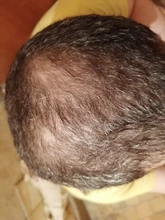 PURC-pulverizador para el crecimiento del cabello, tratamiento para la pérdida de cabello, para adelgazar, cuidado del cabello, 30ml