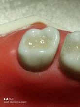 Kit de molde de impresión Dental Posterior, herramientas de llenado de restauración Dental